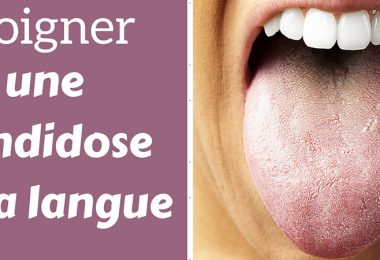 candidose oesophage symptomes candidose oesophage symptomes
